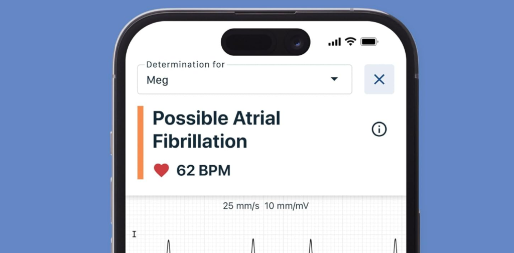 Technological Advancements in Home ECG Monitoring