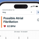 Technological Advancements in Home ECG Monitoring